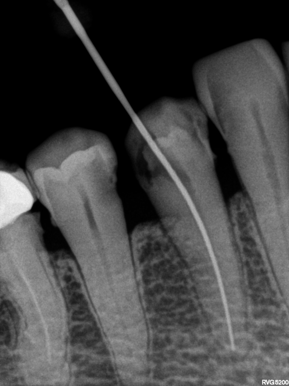 Dental X-ray